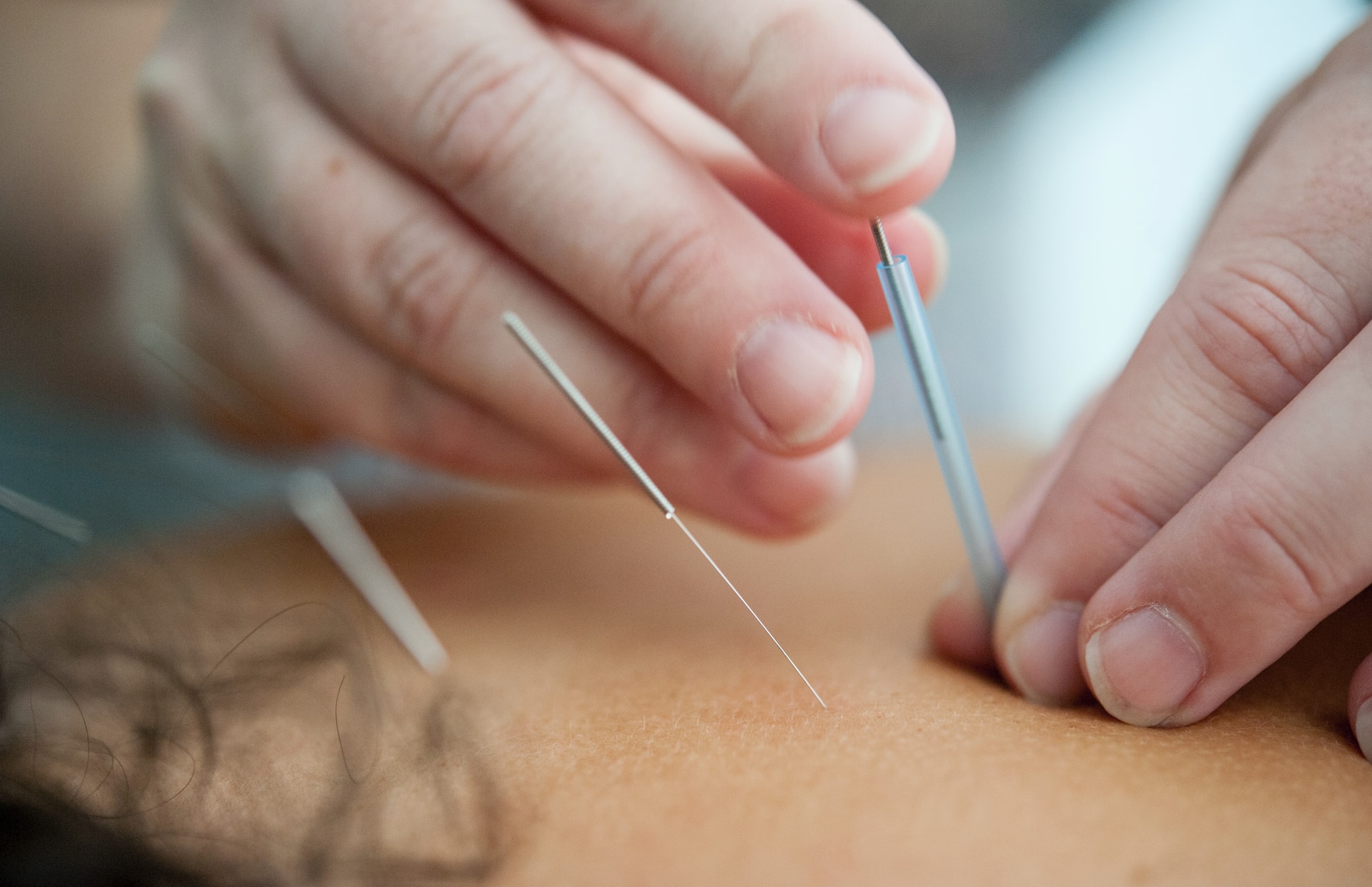 Acupuncture For Disorders
