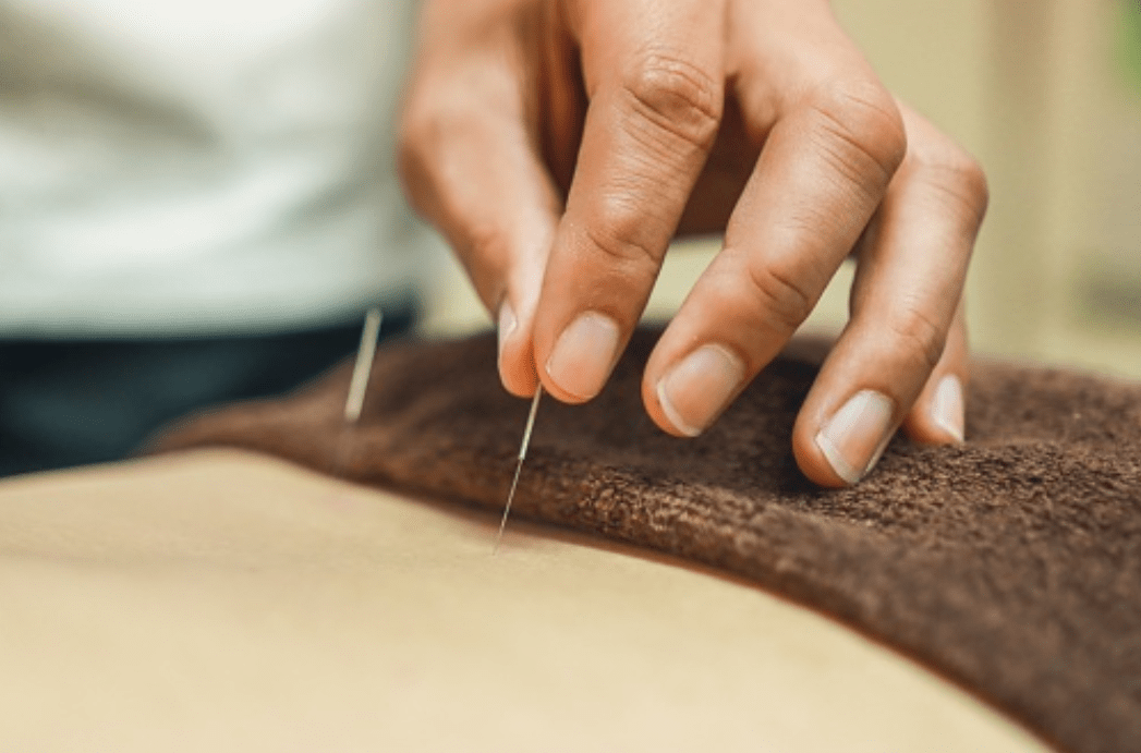 Fertility Acupuncture