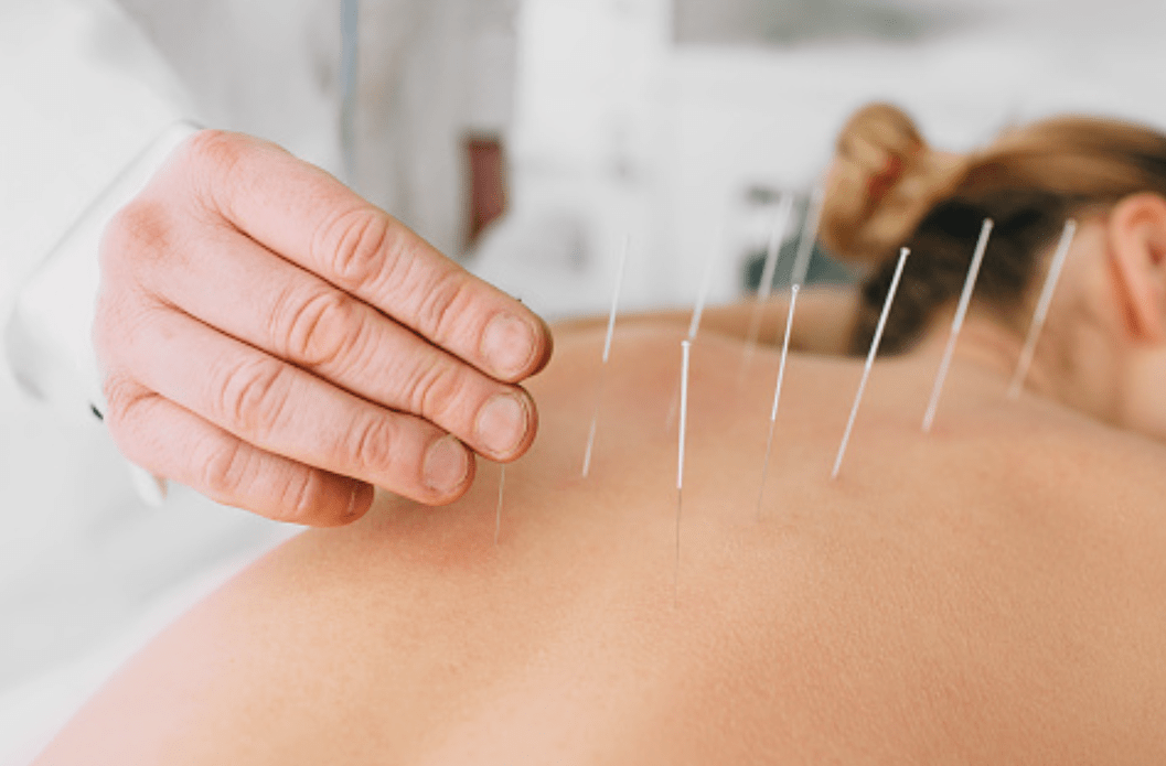 Acupuncture For Weight Loss